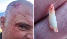 ذا صن: سمكة قرش هاجمت غواصاً في جنوب أفريقيا وتركت إحدى أسنانها برأسه